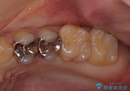 セラミックインレーによる治療の症例 治療前
