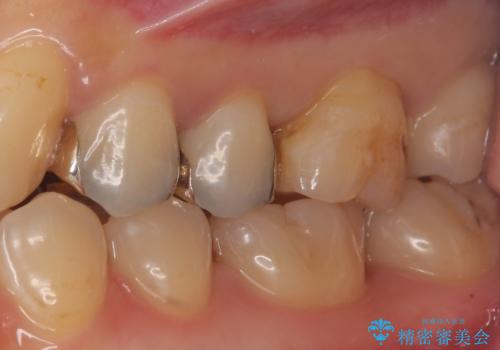 セラミックインレーによる治療の治療前