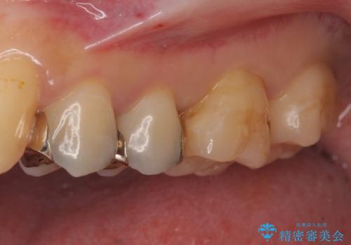 セラミックインレーによる治療の治療前