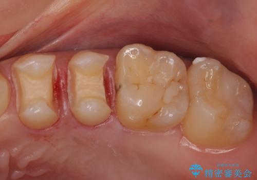 セラミックインレーによる治療の治療中