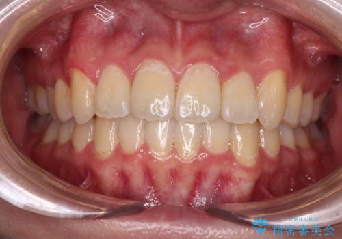 【モニター】八重歯と前歯のクロスバイト　ワイヤーを併用しインビザラインで矯正治療の症例 治療後