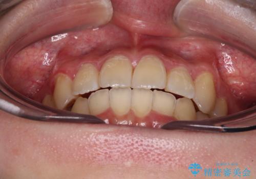 【モニター】八重歯と前歯のクロスバイト ワイヤーを併用しインビザラインで矯正治療の治療後