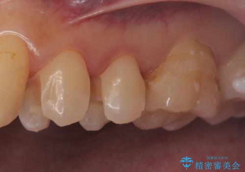 セラミックインレーによる治療の治療中