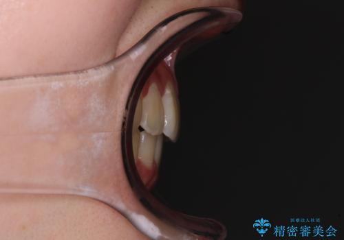 【モニター】八重歯と前歯のクロスバイト ワイヤーを併用しインビザラインで矯正治療の治療後