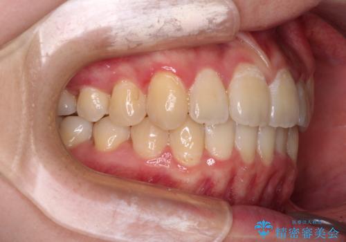 【モニター】八重歯と前歯のクロスバイト　ワイヤーを併用しインビザラインで矯正治療の治療後