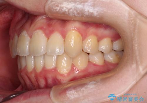 【モニター】八重歯と前歯のクロスバイト ワイヤーを併用しインビザラインで矯正治療の治療後