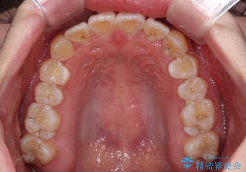 【モニター】八重歯と前歯のクロスバイト ワイヤーを併用しインビザラインで矯正治療の治療後