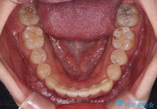 【モニター】八重歯と前歯のクロスバイト ワイヤーを併用しインビザラインで矯正治療の治療後