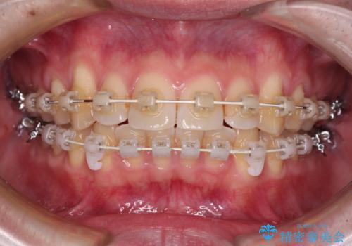 前歯のデコボコを治したい ワイヤー装置でお手軽に矯正治療の治療中