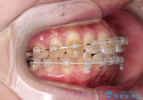 前歯のデコボコを治したい ワイヤー装置でお手軽に矯正治療の治療中