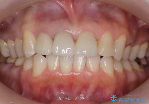 前歯のすき間　以前よりも広がってきた　二度と広がらないようにしたい　セラミック治療の症例 治療後