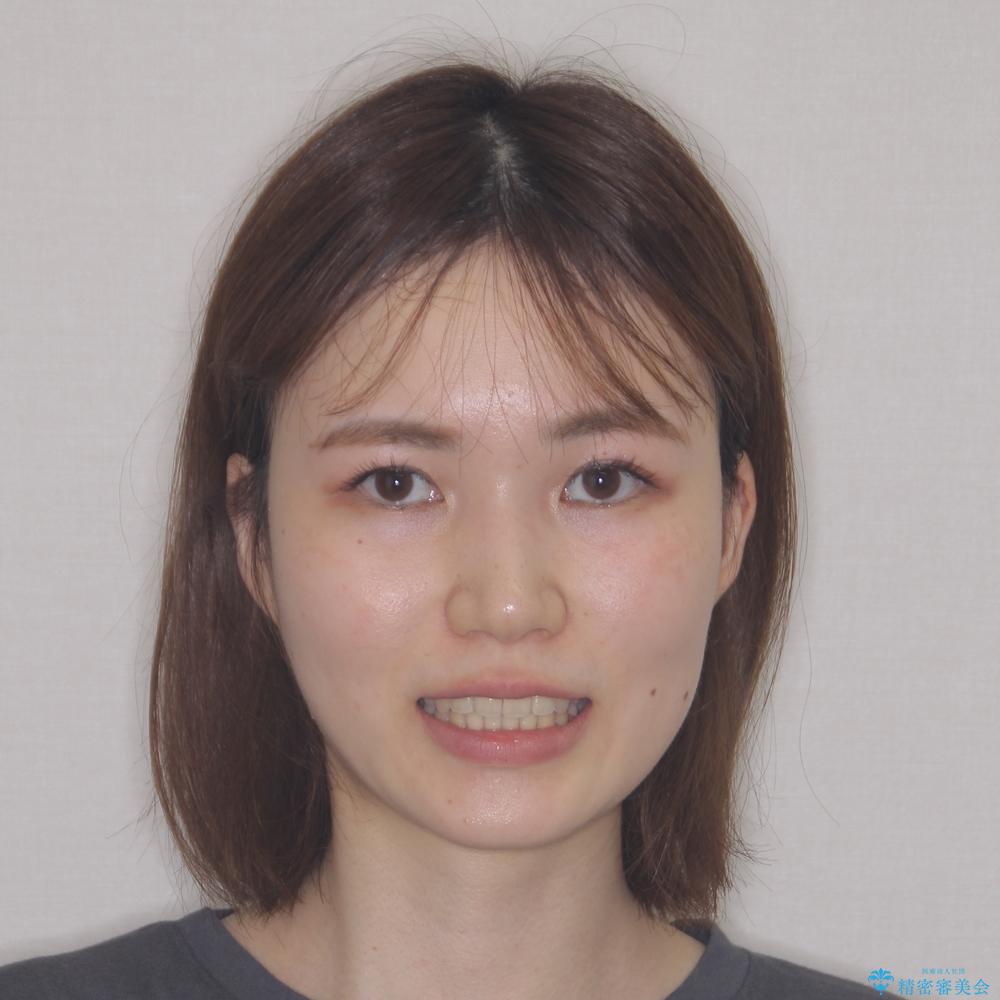 【モニター】八重歯と前歯のクロスバイト ワイヤーを併用しインビザラインで矯正治療の治療後(顔貌)