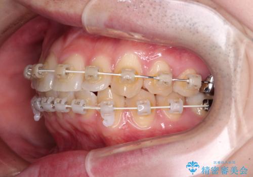 前歯のデコボコを治したい　ワイヤー装置でお手軽に矯正治療の治療中