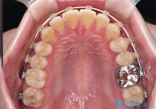 前歯のデコボコを治したい ワイヤー装置でお手軽に矯正治療の治療中