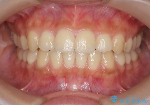 ワイヤー部分矯正を併用して治療期間を短縮 マウスピース矯正治療の症例 治療後