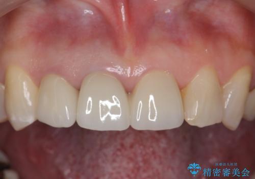 前歯のすき間　以前よりも広がってきた　二度と広がらないようにしたい　セラミック治療の治療後