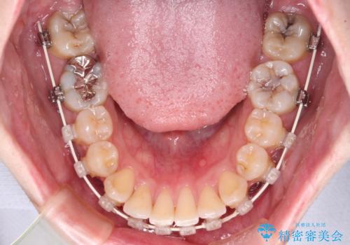 前歯のデコボコを治したい ワイヤー装置でお手軽に矯正治療の治療中