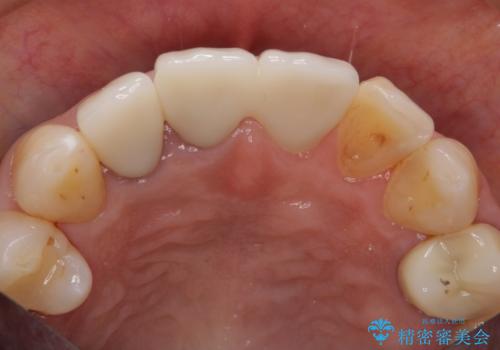 前歯のすき間 以前よりも広がってきた 二度と広がらないようにしたい セラミック治療の治療後