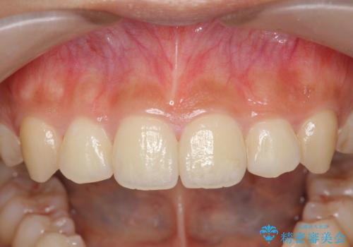 ワイヤー部分矯正を併用して治療期間を短縮 マウスピース矯正治療の治療後