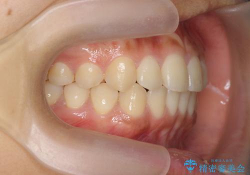 ワイヤー部分矯正を併用して治療期間を短縮 マウスピース矯正治療の治療後