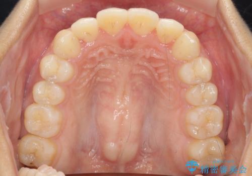 ワイヤー部分矯正を併用して治療期間を短縮 マウスピース矯正治療の治療後