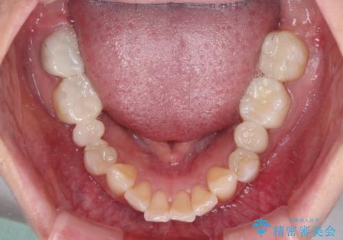 金属の見えてしまったクラウン セラミッククラウンで自然にの治療後