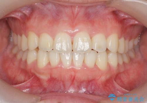 前歯の見た目を改善したいの症例 治療後