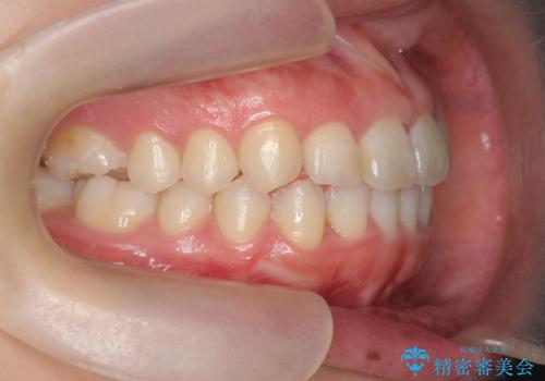 前歯の見た目を改善したいの治療後