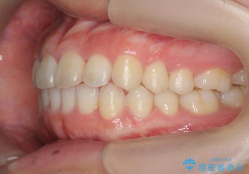 前歯の見た目を改善したいの治療後
