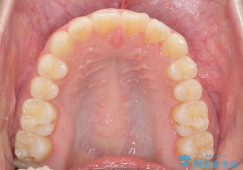 前歯の見た目を改善したいの治療後