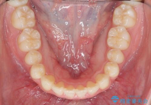 前歯の見た目を改善したいの治療後