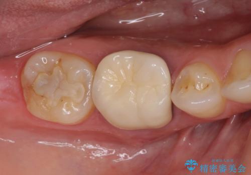 奥歯の歯茎から膿が出る　根管治療とオールセラミッククラウンの症例 治療前