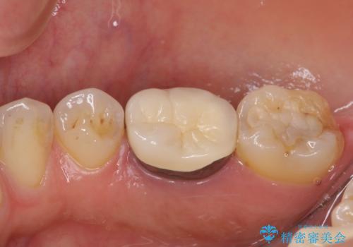 奥歯の歯茎から膿が出る　根管治療とオールセラミッククラウンの治療前