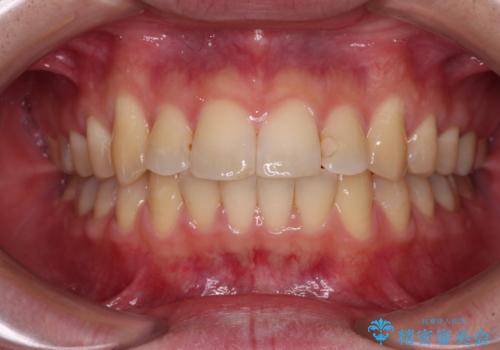 前歯のデコボコを治したい ワイヤー装置でお手軽に矯正治療の症例 治療後