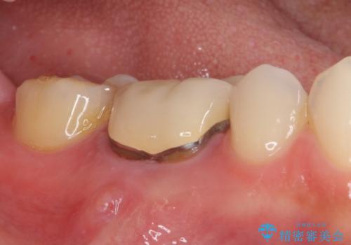 奥歯の歯茎から膿が出る 根管治療とオールセラミッククラウンの治療前