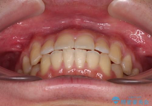 前歯のデコボコを治したい ワイヤー装置でお手軽に矯正治療の治療後