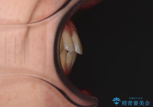 前歯のデコボコを治したい ワイヤー装置でお手軽に矯正治療の治療後