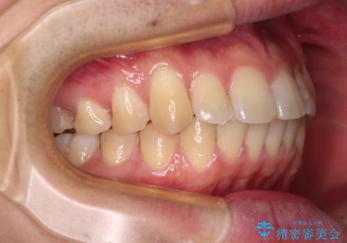 前歯のデコボコを治したい ワイヤー装置でお手軽に矯正治療の治療後