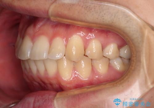 前歯のデコボコを治したい ワイヤー装置でお手軽に矯正治療の治療後