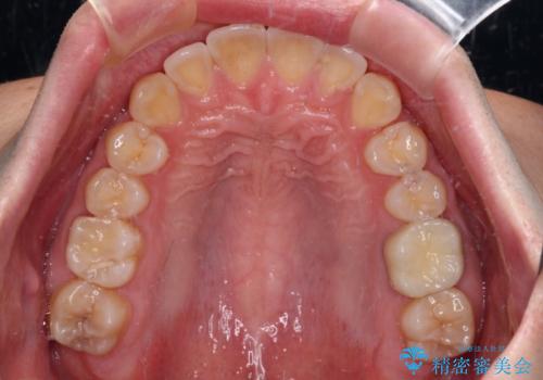 前歯のデコボコを治したい ワイヤー装置でお手軽に矯正治療の治療後