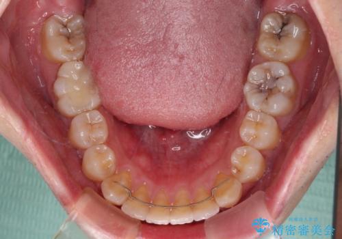 前歯のデコボコを治したい ワイヤー装置でお手軽に矯正治療の治療後