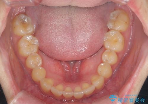 [ インビザライン ]前歯のガタつきを治したいの治療後