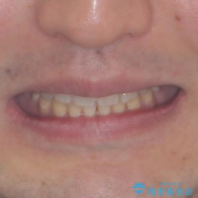やっぱり矯正をしたい セラミック治療の途中から矯正治療スタートの治療後(顔貌)