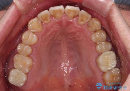 やっぱり矯正をしたい　セラミック治療の途中から矯正治療スタートの治療後