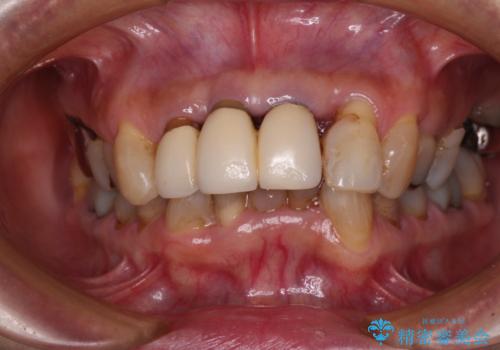 不具合ばかりの前歯 前歯のオールセラミックブリッジの治療前