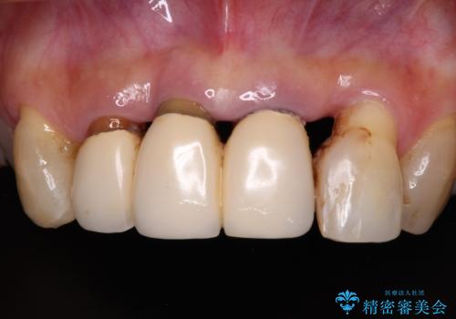 不具合ばかりの前歯　前歯のオールセラミックブリッジの症例 治療前