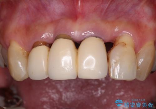 不具合ばかりの前歯　前歯のオールセラミックブリッジの治療前