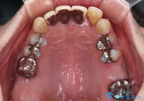 不具合ばかりの前歯 前歯のオールセラミックブリッジの治療前