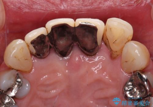 不具合ばかりの前歯 前歯のオールセラミックブリッジの治療前