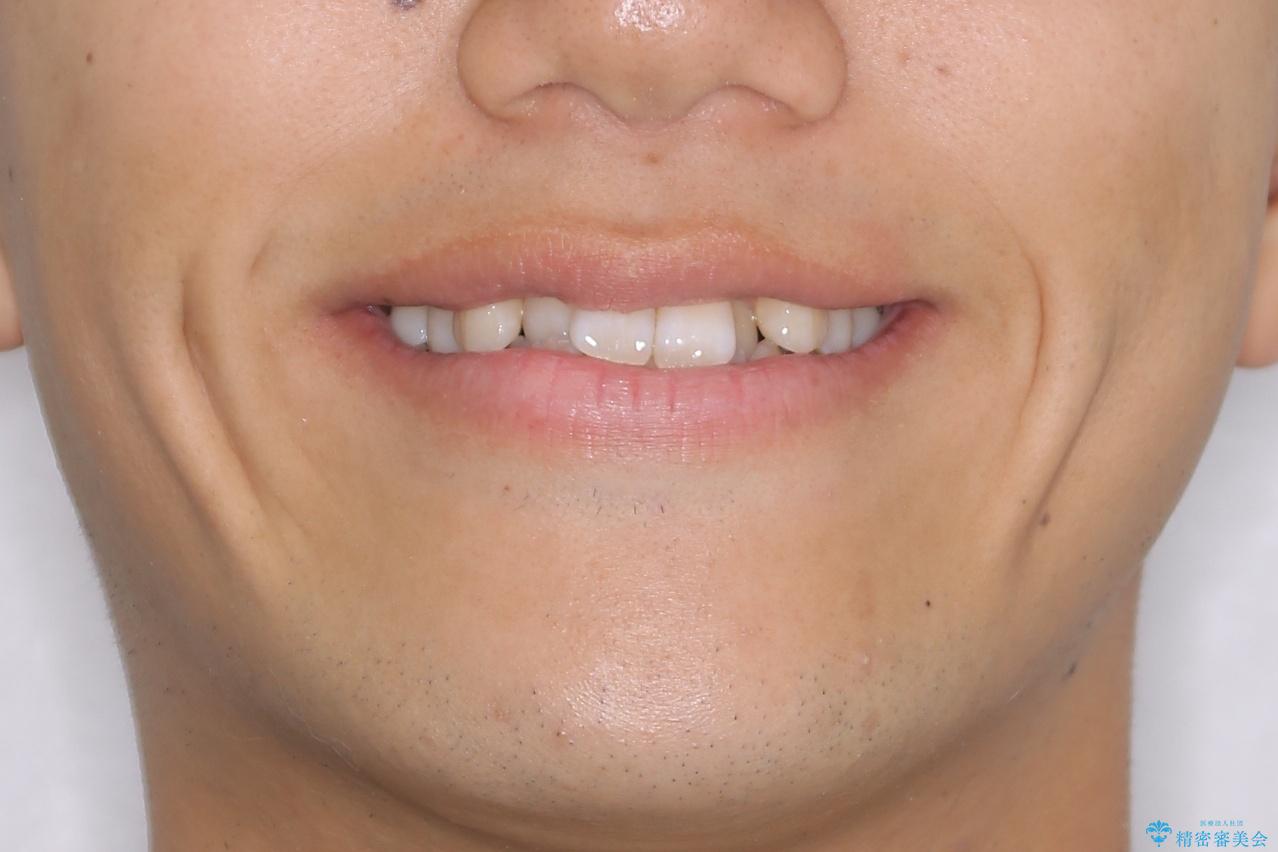 【非抜歯】八重歯を治す マウスピース矯正の治療前(顔貌)